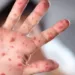 Updated guidelines for prevention and treatment of monkeypox